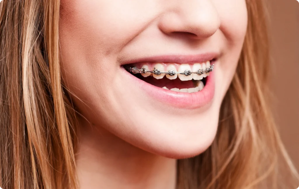 Sourire en gros plan avec bagues orthodontiques métalliques