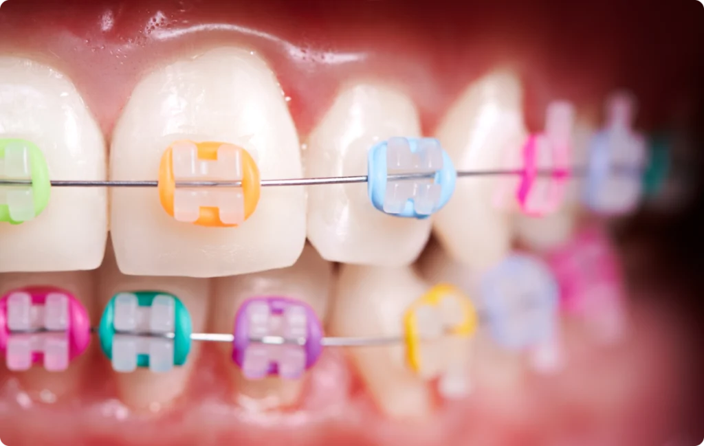 Bagues orthodontiques avec élastiques de couleur en gros plan