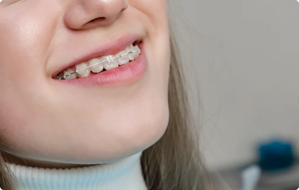 Gros plan sur des brackets en céramique de couleur dent