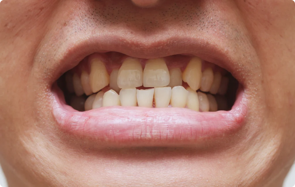 Dents mal alignées d’un adulte avant traitement orthodontique