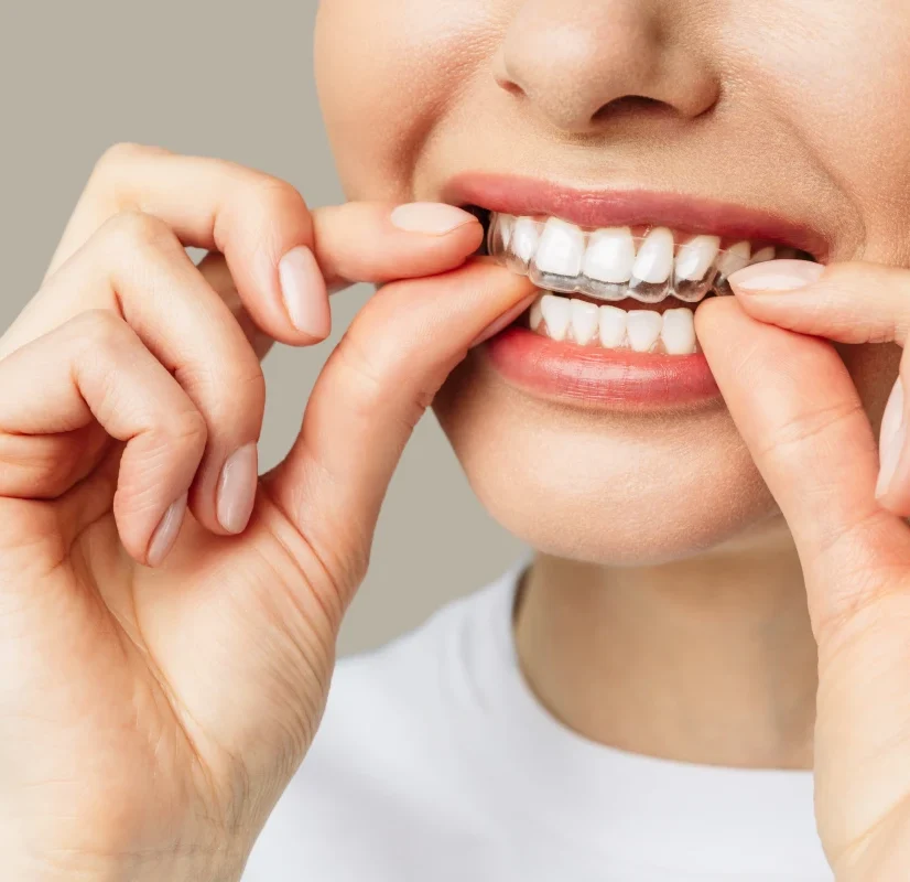 Orthodontie adulte