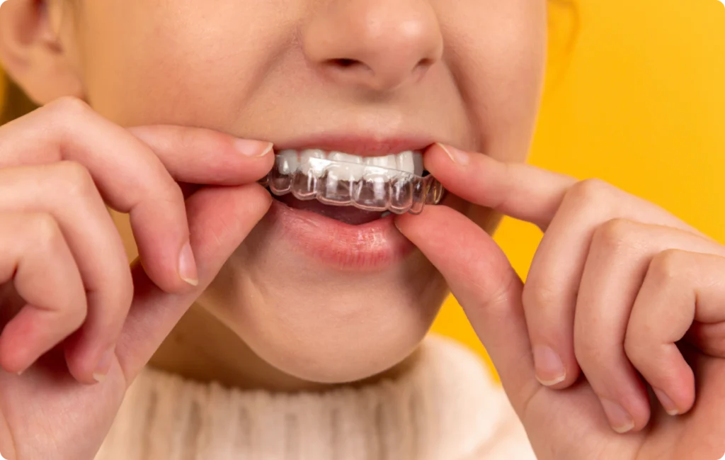 Adolescente insérant une gouttière d’alignement transparente